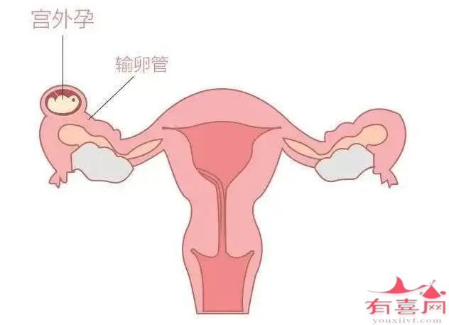怎么治疗输卵管不通+